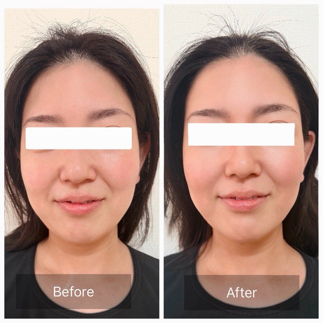 TERAPP Lift Up Patch 使用前後の比較写真（Before / After）。掲載許可をいただいたご利用者の記録。