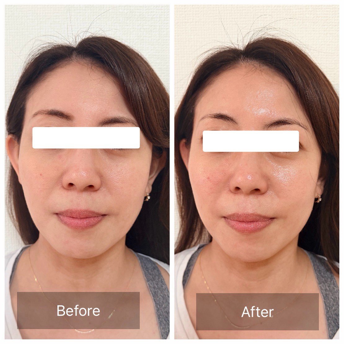 TERAPP Lift Up Patch 使用前後の比較写真（Before / After）。掲載許可をいただいたご利用者の記録。