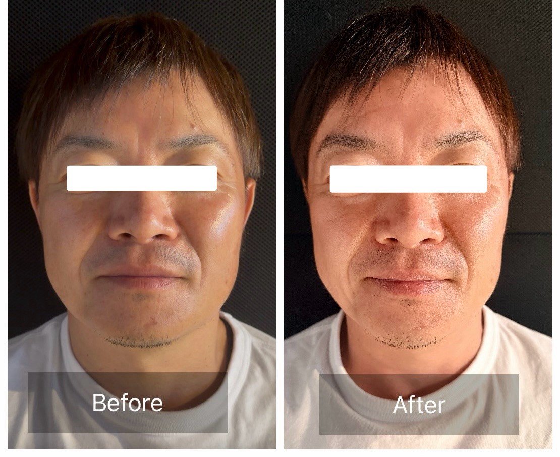 TERAPP Lift Up Patch 使用前後の比較写真（Before / After）。掲載許可をいただいたご利用者の記録。