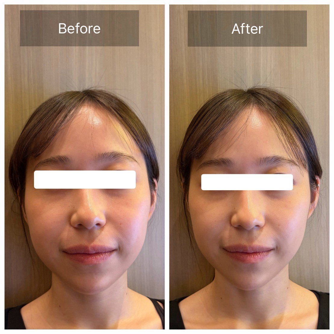 TERAPP Lift Up Patch 使用前後の比較写真（Before / After）。掲載許可をいただいたご利用者の記録。