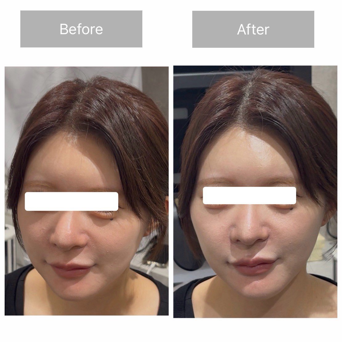 TERAPP Lift Up Patch 使用前後の比較写真（Before / After）。掲載許可をいただいたご利用者の記録。