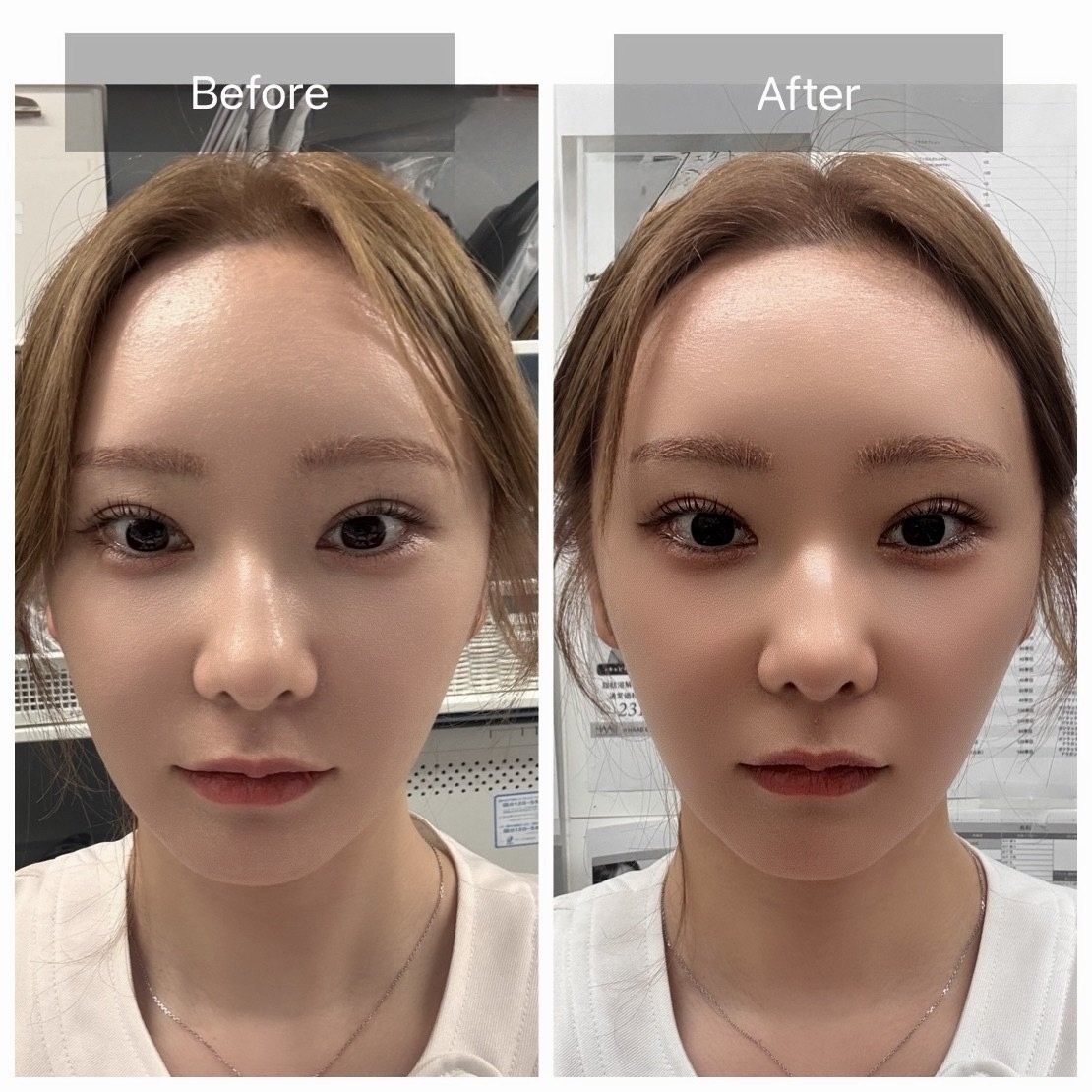 TERAPP Lift Up Patch 使用前後の比較写真（Before / After）。掲載許可をいただいたご利用者の記録。