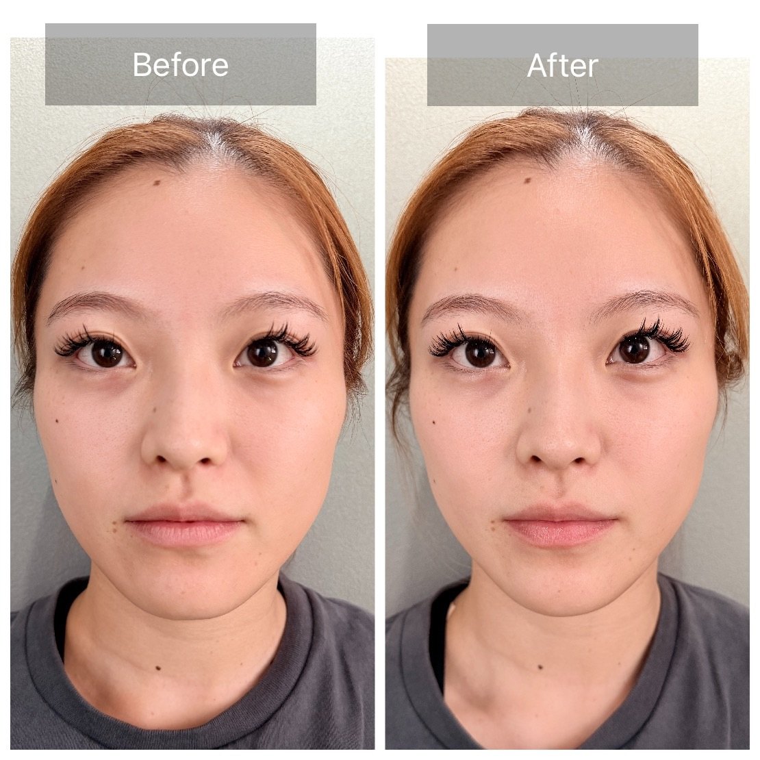 TERAPP Lift Up Patch 使用前後の比較写真（Before / After）。掲載許可をいただいたご利用者の記録。