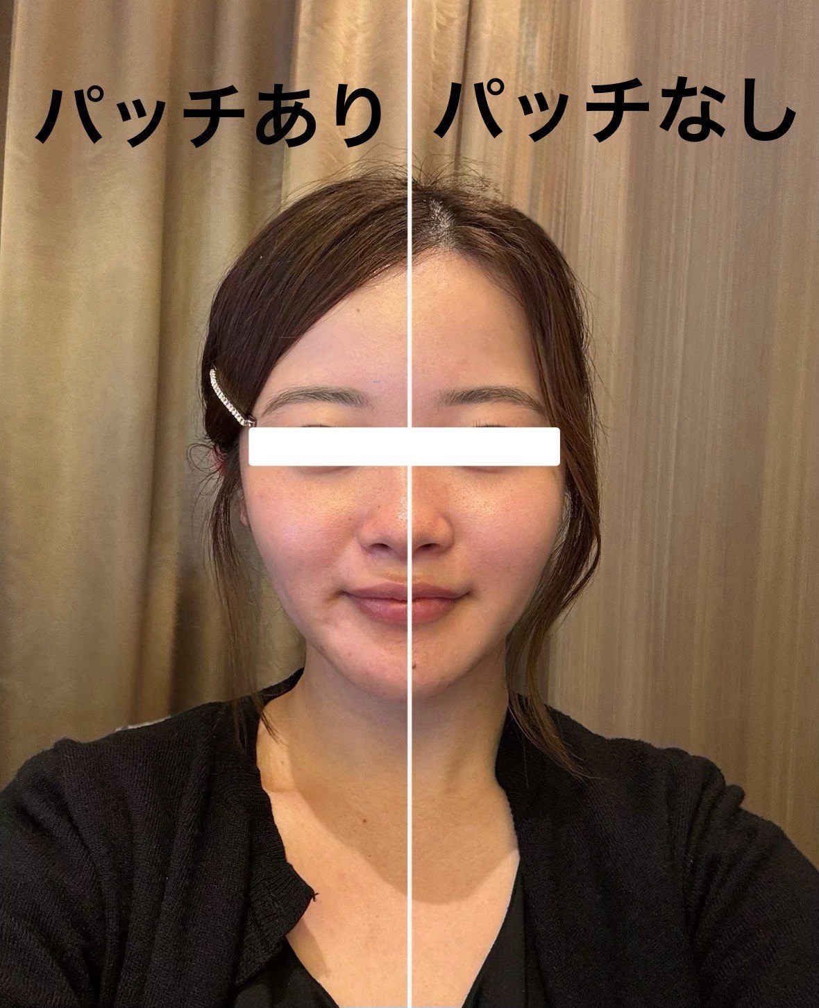 TERAPP Lift Up Patch を貼った側と貼っていない側を並べた比較写真。掲載許可をいただいたご利用者の記録。